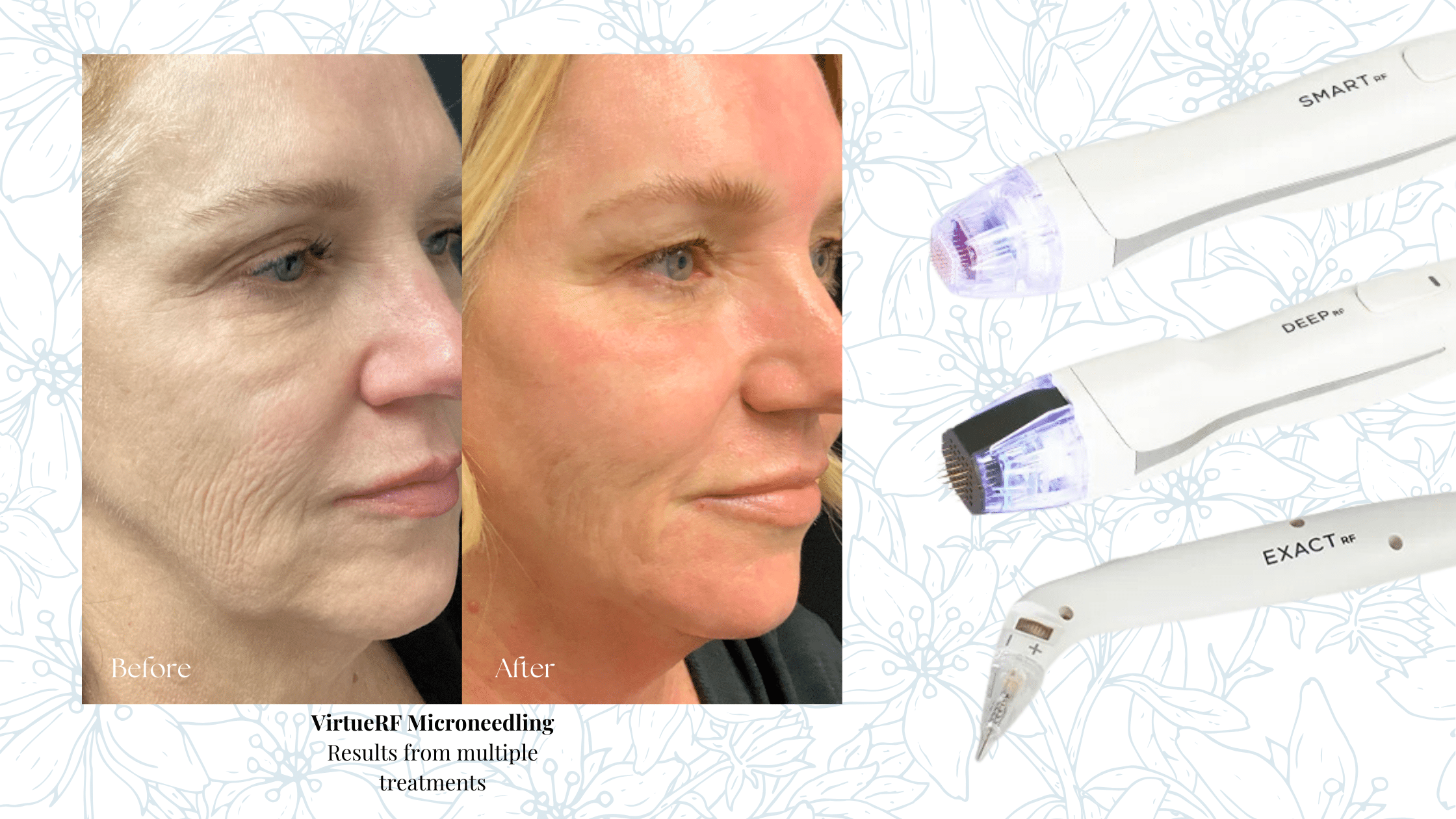 Microneedling treatments in Cincinnati OH & Covington KY