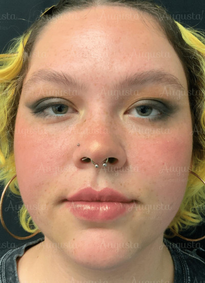 Lip Filler Before And After - Augusta Aesthetics