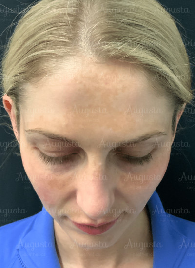 Dermal Filler in Cheeks Before and After