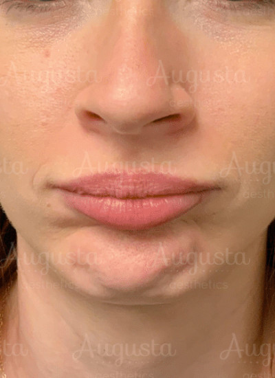 Chin Dimpling Minimization Before and After