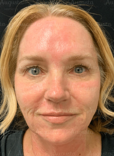 Incredible VirtueRF Microneedling Results