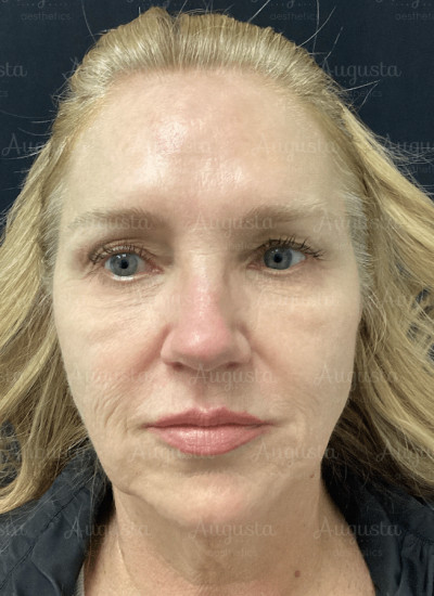 Incredible VirtueRF Microneedling Results