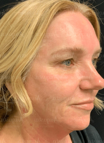 Age Reversing Results from Microneedling (VirtueRF Microneedling With Augusta Aesthetics)