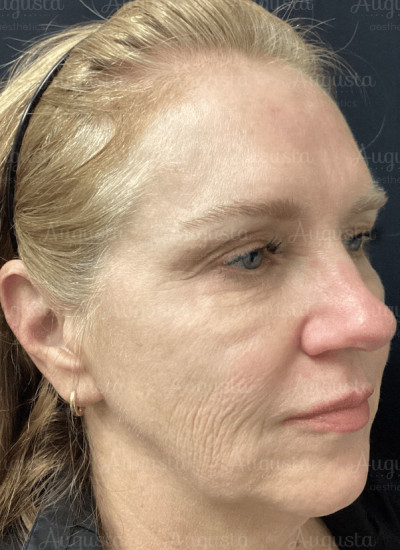 Age Reversing Results from Microneedling (VirtueRF Microneedling With Augusta Aesthetics)