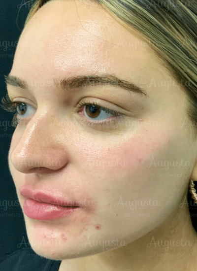 Lips and Cheeks Dermal Filler